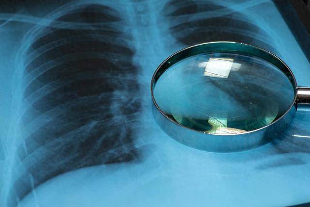 收藏！這4種癌症早期篩查真的有用